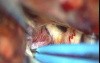  Brain aneurysm - Anterior Communicating Artery Aneurysm - Microsurgical clipping