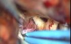  Brain aneurysm - Anterior Communicating Artery Aneurysm - Microsurgical clipping