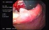 Gastric Carcinoma - Argon Plasma Coagulation (APC) Treatment (1 of 8)