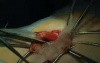 PHS - inguinal hernia repair