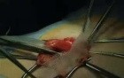 PHS - inguinal hernia repair