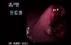 Gastric Adenocarcinoma - Obstruction 1