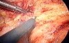 Laparoscopic abdominoperineal resection