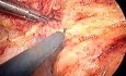 Laparoscopic abdominoperineal resection