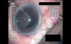 Cataract Surgery XI - Part 4
