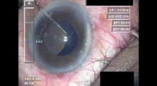 Cataract Surgery XI - Part 4