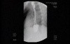 Esophageal Achalasia - Extreme Narrowing of the Esophago-gastric Junction