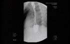 Esophageal Achalasia - Extreme Narrowing of the Esophago-gastric Junction