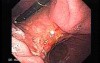 Adenocarcinoma of the Lesser Curvature with Signet Ring Cells (3 of 3) 2