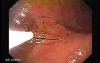Percutaneous Endoscopic Gastrostomy - PEG (2 of 6)