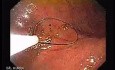 Percutaneous Endoscopic Gastrostomy - PEG (2 of 6)