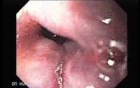 Hemorrhage After Ligation - Some Ligated Varices