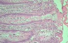 Case on Multiple Adenomas (large polyps) of the Rectum (37 of 37)