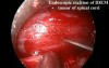 Endoscopic Excition of IDEM tumor of Spinal Cord