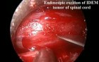 Endoscopic Excition of IDEM tumor of Spinal Cord