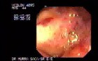 Large Ulcerative Lesion with Marginal Elevation