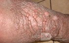 Elephantiasis nostras verrucosa on the legs with morbid
 obesity (5 of 5)