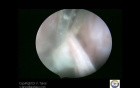 TVL Using Tenaculum For Adhesion Removal 