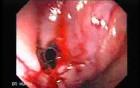 Consecutive colonoscopy with dilation was carried out (14 of 15)