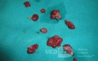 Huge Mass of the Descending Colon (25 of 25)