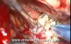 Skull Base Tumor - Dorsum Sella Meningioma - Microsurgical Removal