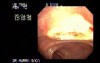 Video Colonoscopic view of a polypectomy of a big 6 cm. x 4 cm. sessile lesion (4 of 4)