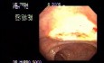 Video Colonoscopic view of a polypectomy of a big 6 cm. x 4 cm. sessile lesion (4 of 4)