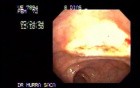 Video Colonoscopic view of a polypectomy of a big 6 cm. x 4 cm. sessile lesion (4 of 4)
