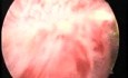Hysteroscopic Treatment Of Intr Uterine Endometrial Polyp