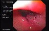 Flexible Endoscopic Suturing - Final Stage of the Procedure