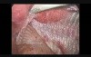 TAPP Hernia Repair In Woman