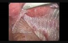 TAPP Hernia Repair In Woman