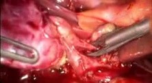 Laparoscopic Treatment Of Cholecystitis