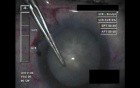 Cataract Surgery IX - Part 1
