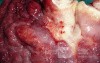 Endoscopy of Scirrhous Gastric Carcinoma involving the entire Fundus, Body and the Antrum (40 of 47)