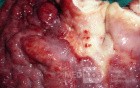 Endoscopy of Scirrhous Gastric Carcinoma involving the entire Fundus, Body and the Antrum (40 of 47)
