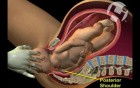 Posterior Shoulder Dystocia with Nerve Root Avulsion