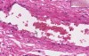 Adhesion - Histopathology - Lung, pleura