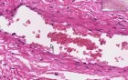 Adhesion - Histopathology - Lung, pleura