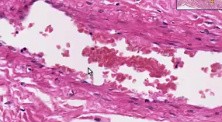 Adhesion - Histopathology - Lung, pleura