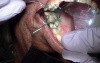 Triple Cord Technique Tooth - CEREC CAD/CAM #3/16