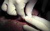 Implant Surgery, #10-11-12-13 Sites