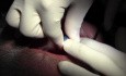 Implant Surgery, #10-11-12-13 Sites