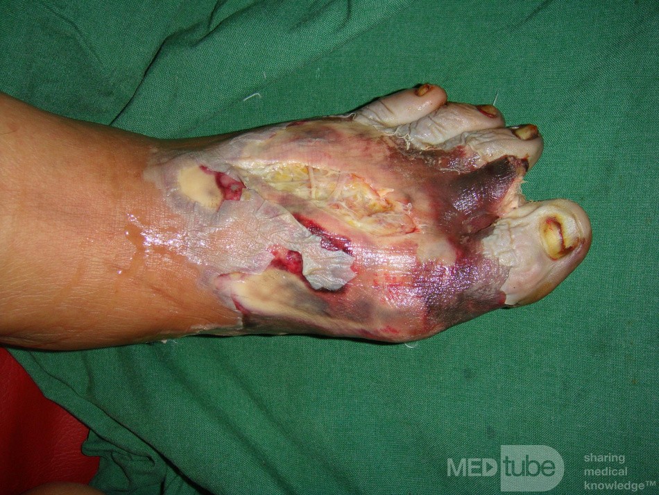 Foot sepsis 