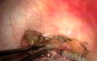 Dermoid of The Corneal Limbus - Ablation