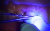 Immediate Implant Rescue