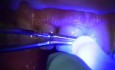 Immediate Implant Rescue