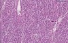Metastatic adenocarcinoma of stomach - Histopathology - Liver