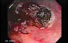 Endoscopic Resection of Giant Tubulo-Villous of the rectum (18 of 35)