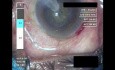 Cataract Surgery IV - Part 2